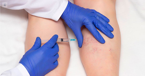 Escleroterapia