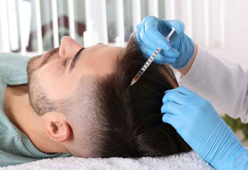 Mesoterapia Capilar
