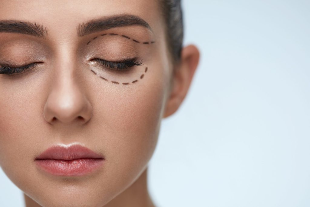 Blefaroplastia