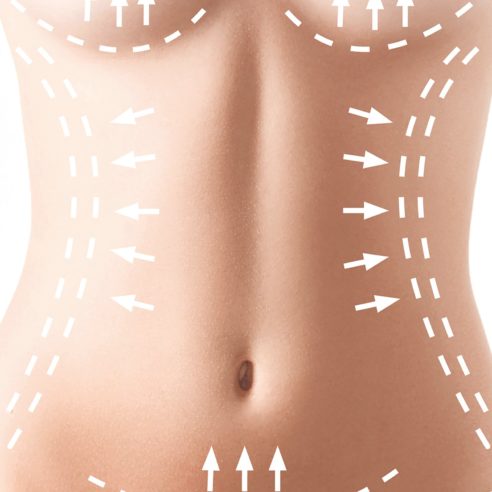 Abdominoplastia